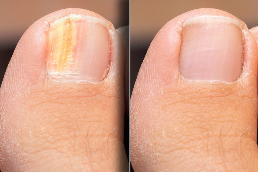 No lado esquerdo, um dedo do pé com uma unha amarelada e com aspecto poroso. No lado direito, um dedo do pé exibe uma unha saudável.